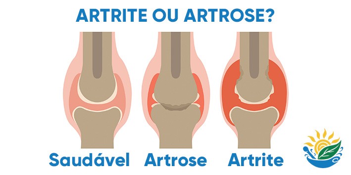 Qual a diferenca entre artrite e artrose